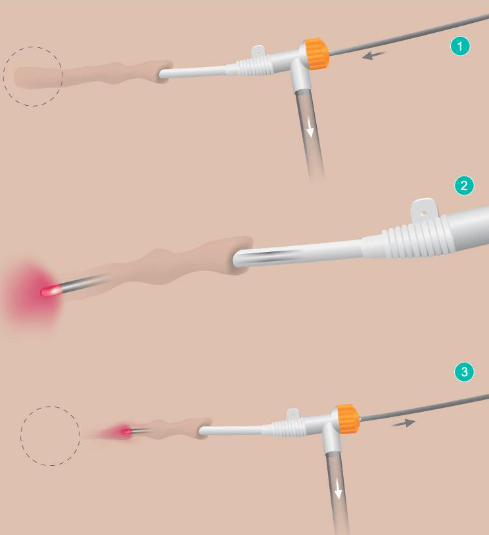 Laser Venous Ablation