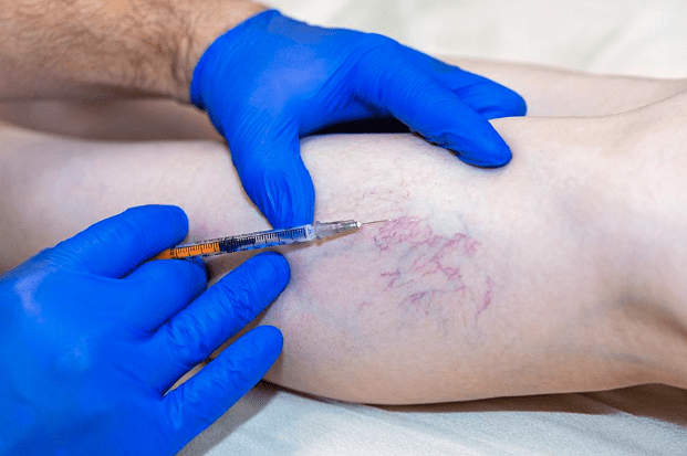 Sclerotherapy