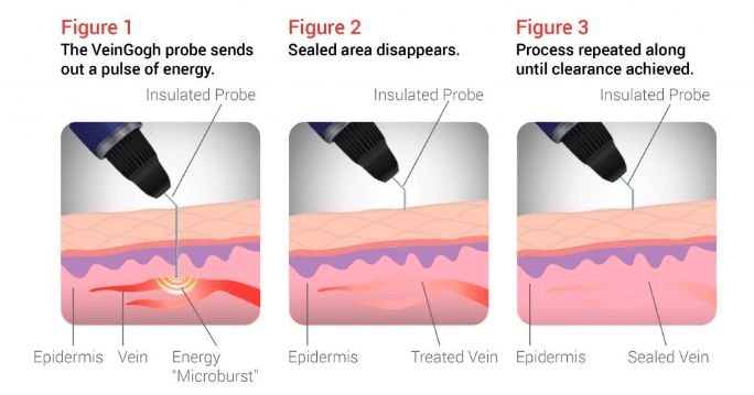 VeinGogh | Fox Valley Surgical Specialists