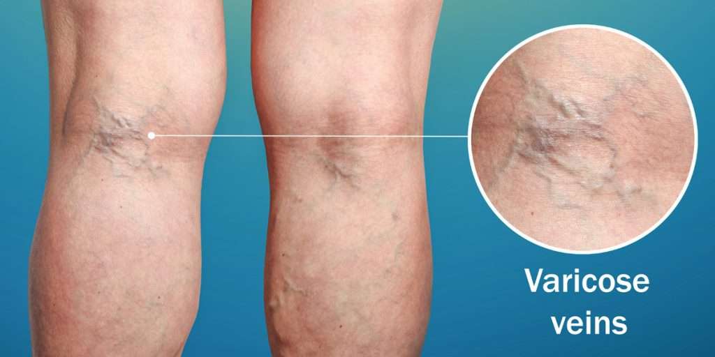 Varicose Veins Tips