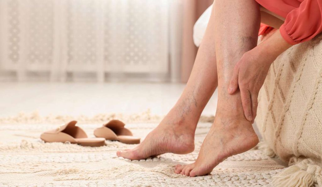 Are Blood Clots Caused by Varicose Veins?