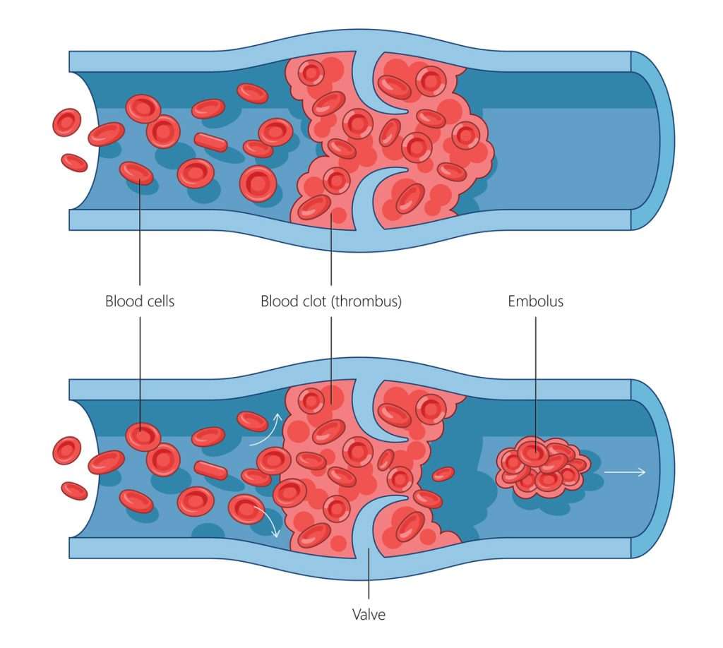 Blood Clot Deep Vein Thrombosis