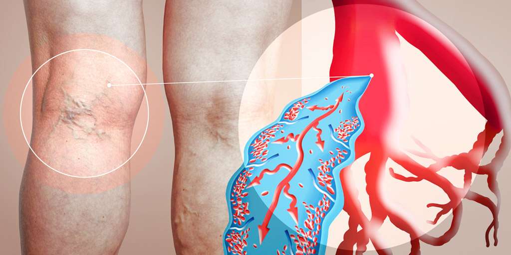 Factors that Contribute to Venous Disease