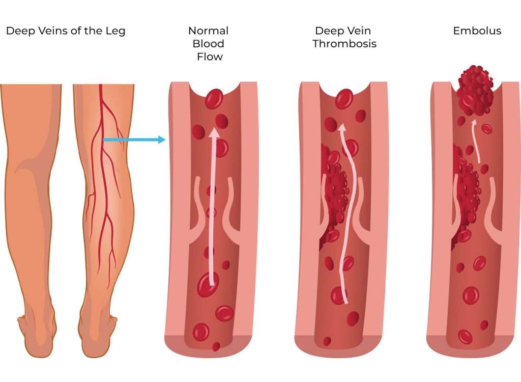 DVT Diagram