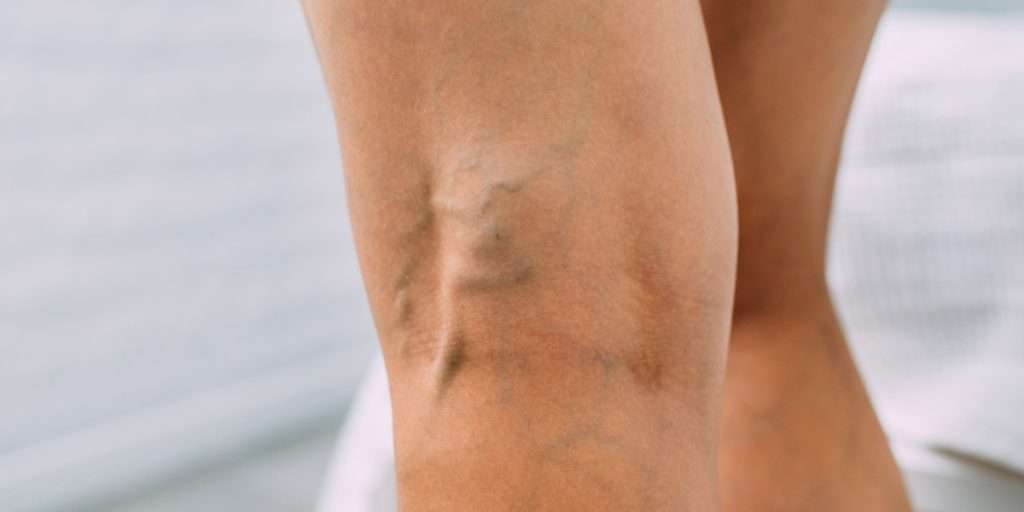 Long Term Varicose Vein Relief