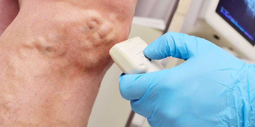 Treating Varicose Veins