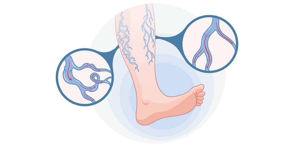 Varicose Vein Diagram