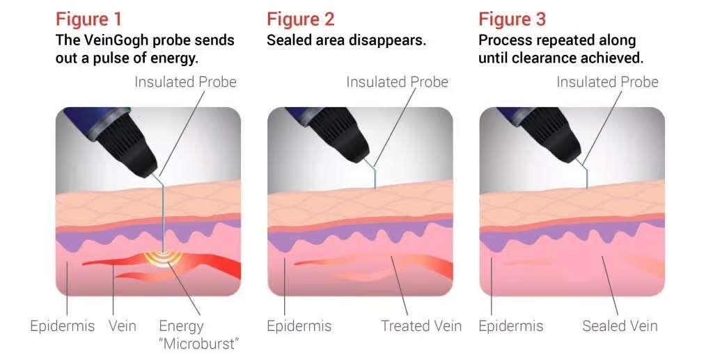 Vein Gogh Procedure