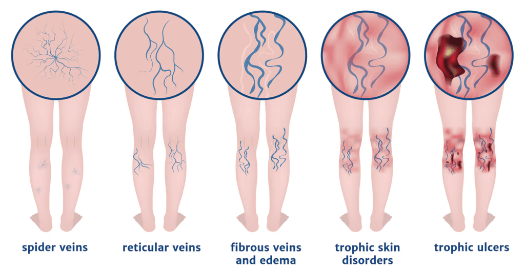 Venous Ulcers