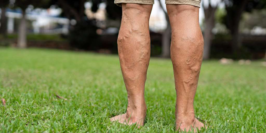 What Happens When Varicose Veins are Left Untreated